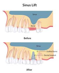 Sinus Lift Surgery