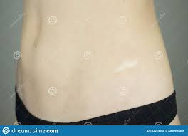 Bauch Eines Madchens Mit Narbe Auf Der Seite Stockfoto Bild Von Anatomie Gesund 162214368