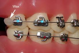 Push the wax against the bracket or wire that's out of place. Emergency Care Goldreich Orthodontics Plano Tx