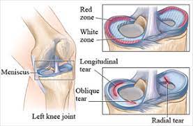 How long after meniscus surgery can i walk? Meniscus Tear Physio Works
