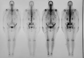 Breast pain is not usually a. Metastatic Bone Disease Fact Sheet Westmead Breast Cancer Institute