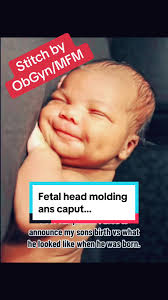 Image result for Vacuum Caput