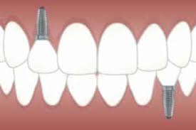 A dental office, as with any medical office, has a staff of administrative support workers. Medical Devices 101 Dental Implants