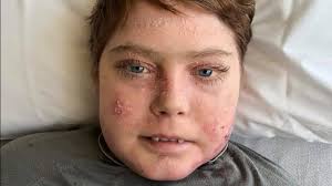 Teen dubbed 'butterfly boy' dies of rare skin disease; Ottawa Senators  mourn his death