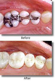 We did not find results for: Does My Composite Filling Hurt Because My Dentist Did A Cheap Job Miranda Lacy Dds