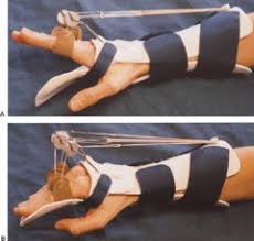 Nbcot Splints Flashcards Quizlet Occupational Therapy Activities Occupational Therapy Occupational Therapy Schools