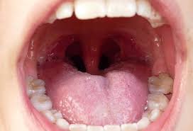 What kind of doctor do i see if i how bad is the recovery? How To Get Rid Of Tonsil Stones Removal Causes Symptoms How To Prevent