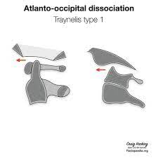 The atlas has 2 cup when the occiput flexes on the atlas its convex joints glides in the opposite direction to the movement of the bone. in english this means that when. Atlanto Occipital Dissociation Injuries Radiology Reference Article Radiopaedia Org