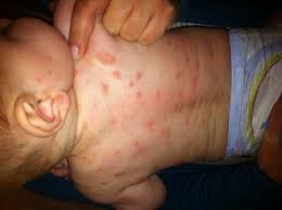 Image result for Eczema nummulare