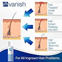 Ingrown hairs can appear in a number of ways. Amazon Com Pfb Vanish Razor Bump Stopper Skin Care Treatment With Chromabright Dark Spot Remover Roll On Formula Treats Ingrown Hairs And Razor Burns 93g Beauty