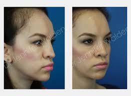 Rhinoplasty Austin TX