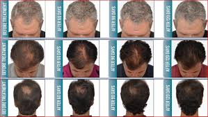 New 80 diode hair low light laser treatment (lllt) hair growth/loss cap/helmet. Lllt Low Level 650nm 670nm Diode Laser Therapy Hair Regrowth System Bs Ll7h Lumsail Medical Aesthetics Industrial Inc
