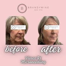 ✨ The results speak for themselves! ✨ Check out this amazing Vivace before  & after! 🙌 Ready to rejuvenate your skin? Let's make it happen! Call our  office or use the link