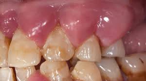 Image result for Periodontal Abscess