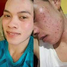 Alpha lipid bee venom cream merupakan botox tanpa suntikan no 1 di dunia. Bee Venom Hq Testimoni Bee Venom Whatsapp Facebook