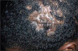 Tips for tender scalp, sore scalp, inflamed scalp on natural hair, how to treat hey everyone,i wanted to get this video out to you guys bc the winter is. Painful Scalp Lesions And Hair Loss Photo Quiz American Family Physician