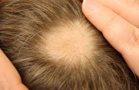 Loss Of Hair Might Be Irregular If You Are Shedding More Than 100 Hairs A Day This Might Result In Help Hair Loss Hair Remedies For Growth Thick Hair Remedies