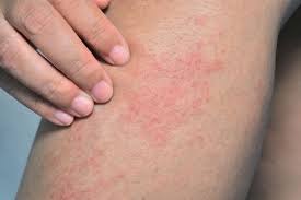 Image result for allergy rash on the legs