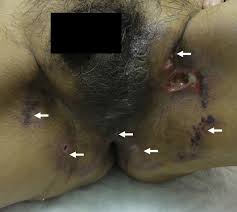 Image result for sore skin in the groin area