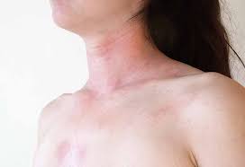 There are many causes of skin rashes; 10 Effective Home Remedies For Skin Allergies