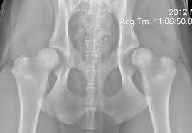 Image result for Hip XRay