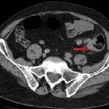 A ct scan can help doctors find cancer and show things like a tumor's shape and size. Abdominal Ct Scans In Series Indicating The Sigmoid Colon Cancer Download Scientific Diagram
