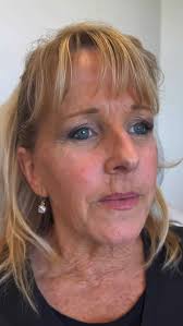 Dr. Howard Levinson empowers his patients through knowledge. Here, he  explains how a breast implant works within the body. Interested in learning  more? Schedule a consultation with him