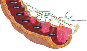 Bowel cancer can spread through the wall of your bowel to the surrounding tissues, and to your lymph nodes nearby. Colorectal Cancer Rhythm Biosciences