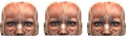 Occurence of bacillus botulinus in nature, j. Applied Anatomy For Botulinum Toxin Injection In Cosmetic Interventions Springerlink