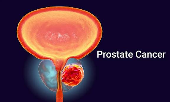 Advanced Prostate Cancer Radioligand Therapy