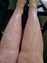 See reviews, times, & insurances accepted. Freedomroo Woman S Body Reacted With Huge Hot Hives After Laser Hair Removal Procedure Australiannewsreview