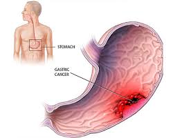 Stomach cancer can cause several symptoms. Gastroenterology Treatment In Vellore Gastroenterology Homeopathy Treatment And World Class Homeopathy In Vellore Acute Gastroenteritis Homeopathic Peptic Ulcer Homeopathy Esophageal Cancer Homeopathic Treatment Gastric Cancer Homeopathic