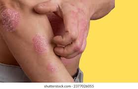 Image result for Eczema nummulare