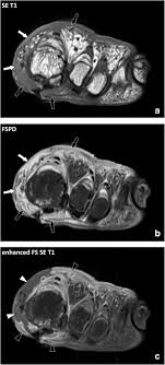 We did not find results for: Fasciae Of The Musculoskeletal System Mri Findings In Trauma Infection And Neoplastic Diseases Insights Into Imaging Full Text