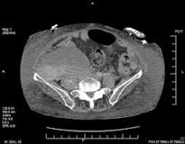 Image result for icd 10 code for psoas muscle hematoma