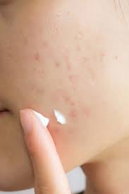 The market's top offerings await you below. How To Get Rid Of Acne Scars Treatments And Home Remedies