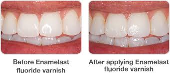 This has an even greater fluoride uptake. How Long Does Tooth Varnish Last