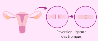 C'est le problème d'une maman de 32 ans qui a eu une ligature des trompes il y a 10 ans. Ligature Des Trompes Et Grossesse Definition Prix Et Risques