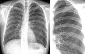 Thoracic tumors a roentgen study j. Pneumothorax Eref Thieme