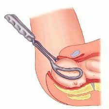 Image result for Forceps Assisted Delivery