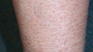 Image result for Ichthyosis