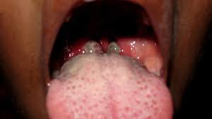 Many people with throat cancer experience pharyngitis, more commonly known as a sore throat, and the sensation of something stuck in the throat. Sore Throat Treatment Causes Diagnosis Symptoms More