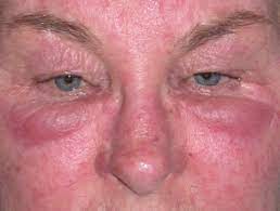 It can be difficult to treat and may require a purpose: Morbihan Disease Dermnet Nz