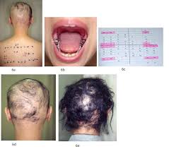 Some hair loss treatments for women are the same as those for men and depend on the cause of hair loss. Herb Lotions To Regrow Hair In Patients With Intractable Alopecia Areata