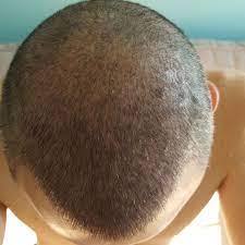 11 days after hair transplant, Hair, 14 Personalisiert Typen -  birgelecekakademi.com