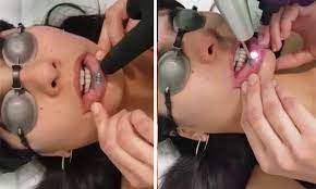 Doremus 4 also noted that tattoos can make it more difficult to detect skin. Australian Woman Has Lip Tattoo Removed With A Laser In Painful Procedure Daily Mail Online