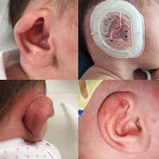 Was aber nicht unbeding vom liegen kommt sie bewegt den kopf in beide. Abstehende Ohren Beim Baby Was Tun