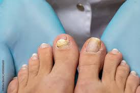 Image result for Onycholysis feet