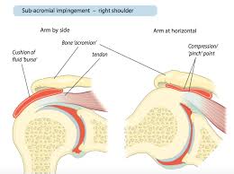 It may also occur when a person has a bad fall or accident. Shoulder Pain Campbell Hand Shoulder Surgeon Southampton