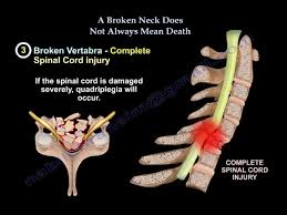 Cutting all the strings at one time (as some people do) can cause problems. Cervical Spine Fracture Neck Fracture Everything You Need To Know Dr Nabil Ebraheim Youtube